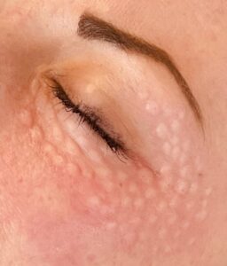 Contour de l'oeil - médecin esthétique agde - Dr Katel Benjamin