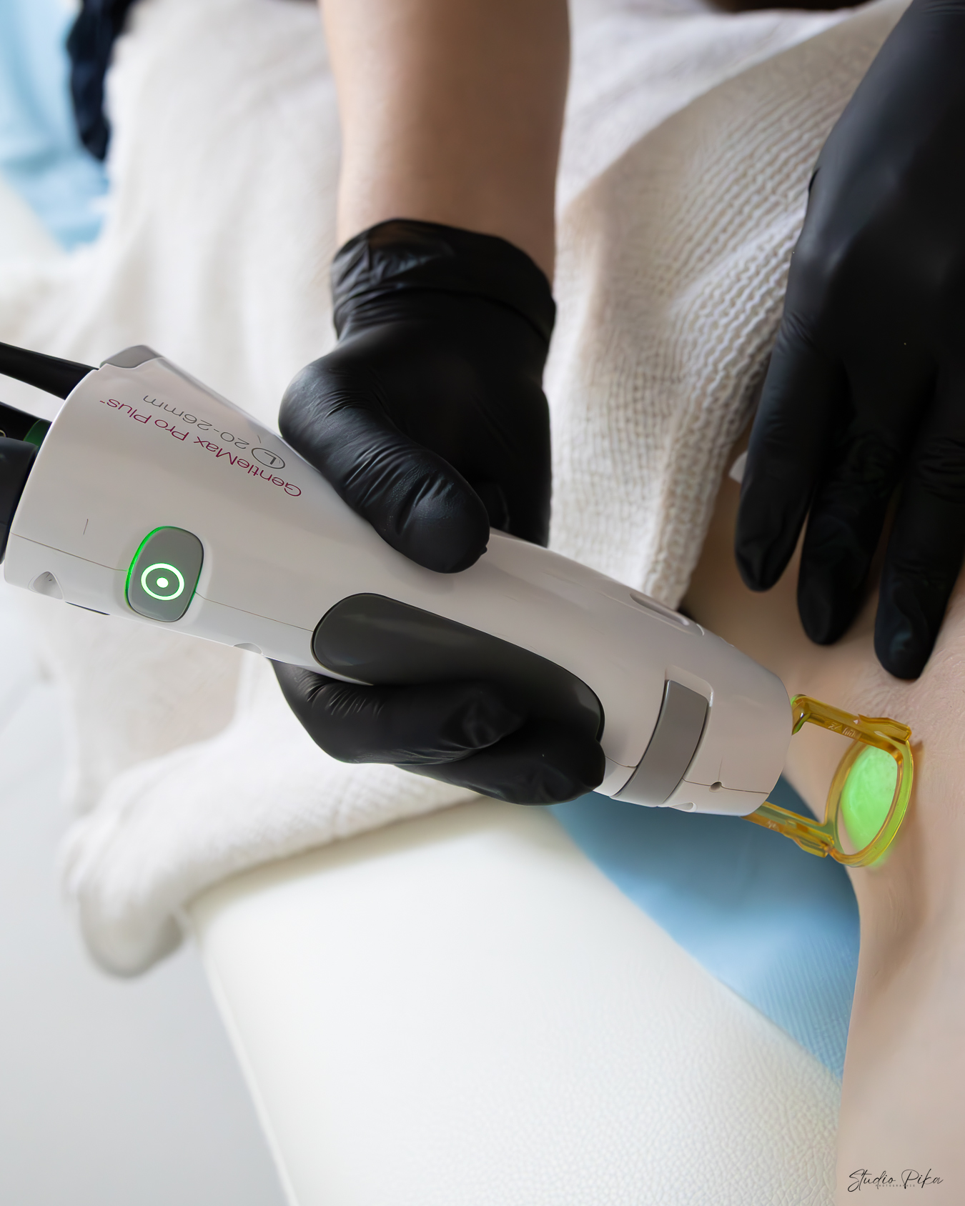 ÉPILATION PERMANENTE AU LASER - Cabinet de médecine esthétique agde - Dr Benjamin Katel ©Studio Pika Com' Photographies-4